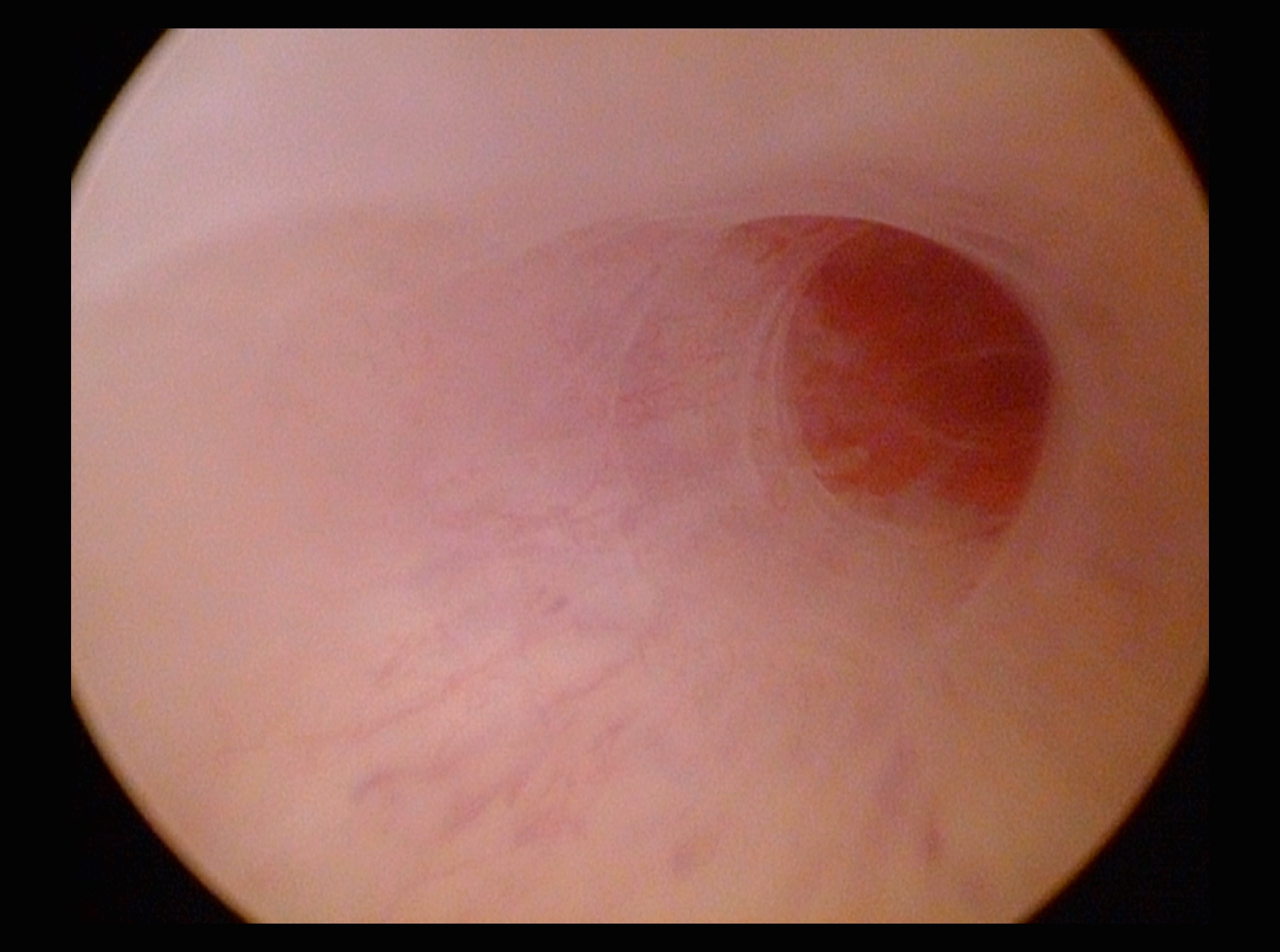 Hysteroscopy Normal Fallopian Tube Ostium  Left